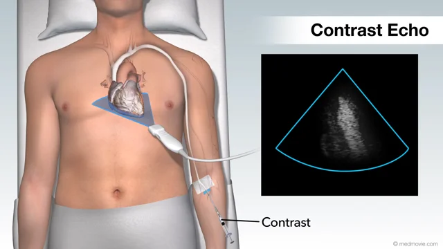 Contrast Echocardiography